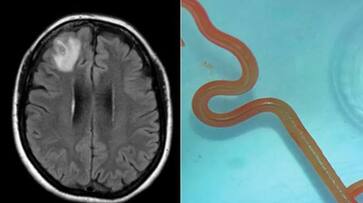 A Australia woman suffering from depression had an 8 cm long live worm in her brain akb A Australia woman suffering from depression had an 8 cm long live worm in her brain akb