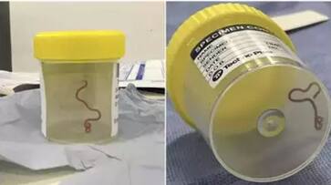 doctors removed live worm from womans brain hyp doctors removed live worm from womans brain hyp