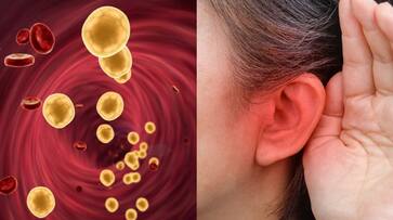 Warning Signs of High Cholesterol Affects Ears azn Warning Signs of High Cholesterol Affects Ears azn
