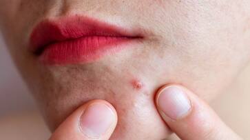 Try these Tips to Help Overcome acne azn Try these Tips to Help Overcome acne azn
