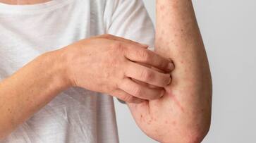 clade 9 chickenpox variant in india found symptoms and prevention-rse- clade 9 chickenpox variant in india found symptoms and prevention-rse-