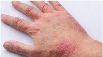 gulf news over ten thousand children suffer from Atopic Eczema in kuwait rvn gulf news over ten thousand children suffer from Atopic Eczema in kuwait rvn
