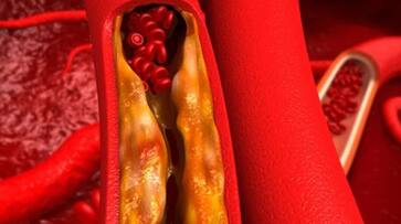 Tips that can help lower cholesterol levels azn Tips that can help lower cholesterol levels azn