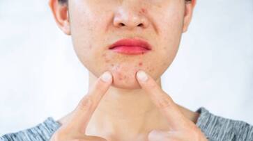 high cholesterol symptoms on face hyp high cholesterol symptoms on face hyp