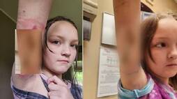 9 years old girl complains of a pinch then discoverd by mother that Spider Bite Quickly Spread zrua