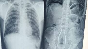 cool drinks bottle found inside stomach 45 year old man admitted in pudukkottai hospital ans cool drinks bottle found inside stomach 45 year old man admitted in pudukkottai hospital ans