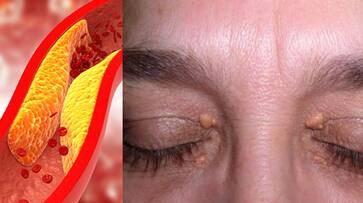 high cholesterol symptoms you must know azn high cholesterol symptoms you must know azn