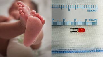One and a half centimeter LED bulb found in seven-month-old lungs in kerala - bsb One and a half centimeter LED bulb found in seven-month-old lungs in kerala - bsb