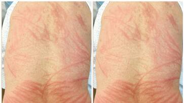 Red spots and excruciating pain in skin after eating mushrooms bkg Red spots and excruciating pain in skin after eating mushrooms bkg