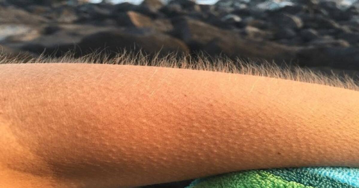 உடலில் புல்லரிப்பு ஏற்படுவதற்கான காரணம் என்ன தெரியுமா? 