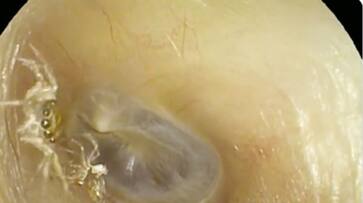 doctors found living spider inside the ear of a woman hyp doctors found living spider inside the ear of a woman hyp