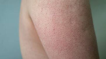 Warning signs of vitamin C deficiency on your skin azn Warning signs of vitamin C deficiency on your skin azn