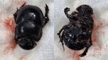 An 8-month-old baby admitted with breathing issue, doctors found Asiatic rhinoceros beetle in baby's throat An 8-month-old baby admitted with breathing issue, doctors found Asiatic rhinoceros beetle in baby's throat