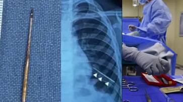 needle in 7 boy lung doctors use magnet to remove it Delhi SSM needle in 7 boy lung doctors use magnet to remove it Delhi SSM