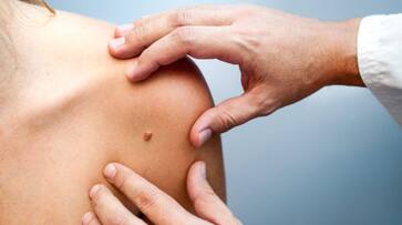 signs and symptoms of skin cancer signs and symptoms of skin cancer