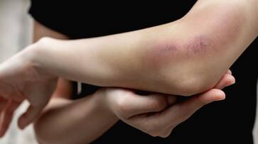 Signs and symptoms of Vitamin K deficiency Signs and symptoms of Vitamin K deficiency