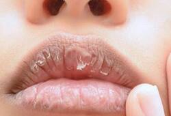 how to take care of chapped lips zkamn