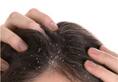 7 Homemade Remedies for Dandruff free scalp nti