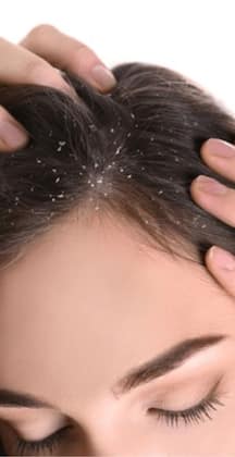 how to get rid of dandruff naturally at home in tamil