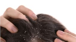 If dandruff occurs in hair in summer then follow these tips ram