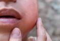 Mumps outbreak in Kerala, over 11,000 cases: What is mumps and its symptomsrtm