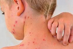 Scary number of chickenpox patients revealed in Kerala, 9 people died know about chickenpox symtoms xbw