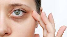 home remedies for remove dark circles 