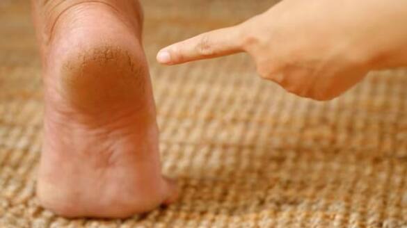 kitchen remedies to help you get rid of cracked heels