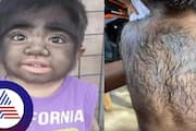 Hairiest Boy Diagnosed With Rare Werewolf Syndrome Here is All You Need To Know About It skr