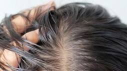 5 Effective tips to avoid greasy hair this summerrtm 