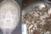 woman with stuffy nose and facial pain discovered hundreds of maggots inside in Thailand 