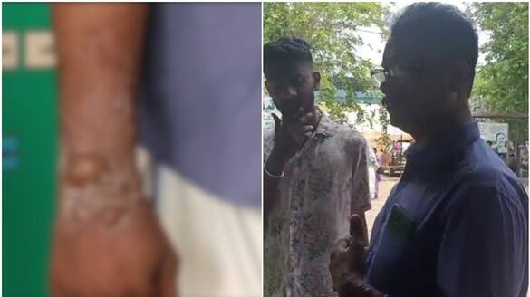 sun stroke made severe burns on 53 year old man from nilambur