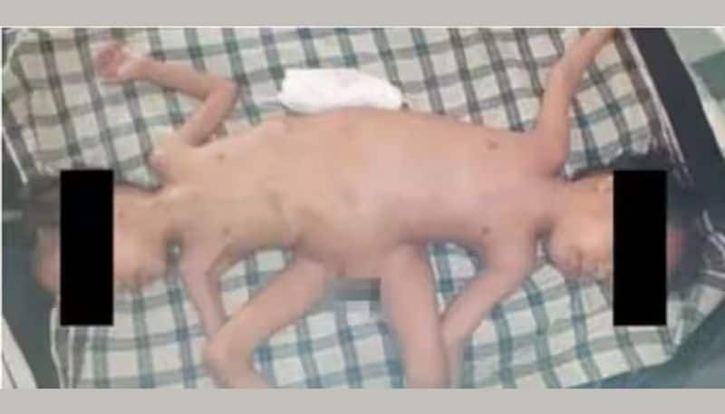 Rare Indonesian conjoined twins, born with 4 arms & 3 legs, undergo surgical correction KRj