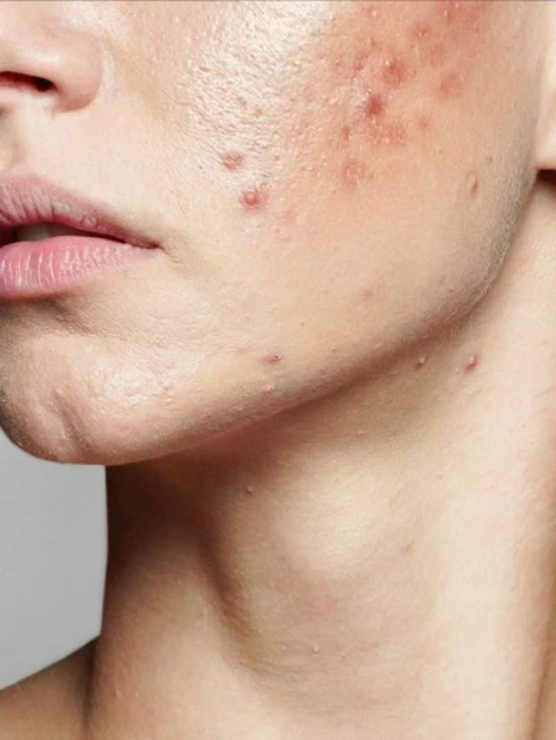 5 Tips To Avoid Summer Acne Breakouts