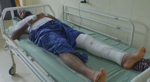 man had leg fracture after his leg  got stuck in broken concrete slab on road side