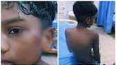 12 year old boy brutally attacked by a Rottweiler dog in chennai hospitalised