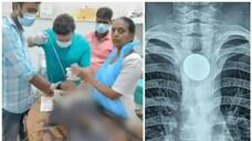 12 year old with throat pain came to district hospital and a coin he swallowed 7 year ago removed