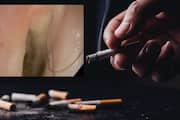 due to heavy smoking 52 Year Old Man developed hair in throat san