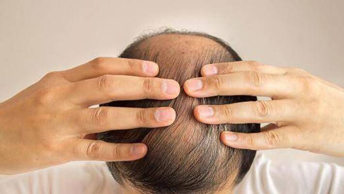 5 oils to avoid baldness 5 oils to avoid baldness