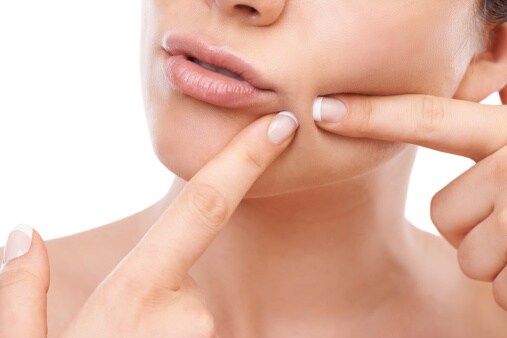overnight hacks to get rid of acne