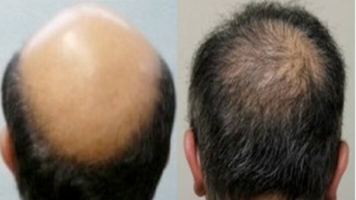 Do you know If you use these tips the hair on the bald head will grow ... Do you know If you use these tips the hair on the bald head will grow ...