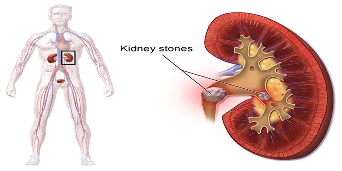 How to remove kidney stones naturally