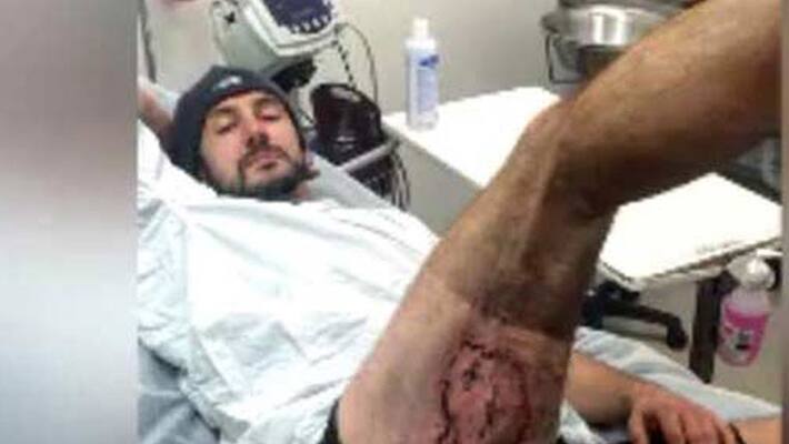 Man Sustains Severe Burns After iPhone 6 Explodes In His Pocket Man Sustains Severe Burns After iPhone 6 Explodes In His Pocket
