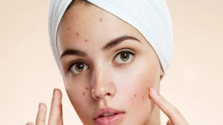 Here are some of the best tips to get rid of acne ... Here are some of the best tips to get rid of acne ...