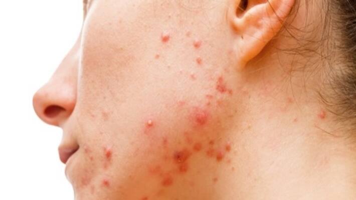 how to control pimple mark on the face how to control pimple mark on the face