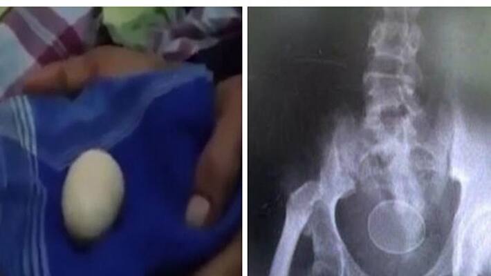 Teenage boy lays 20 eggs out of his bum leaving doctors baffled Teenage boy lays 20 eggs out of his bum leaving doctors baffled