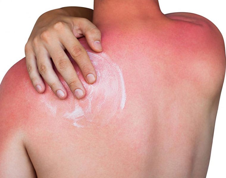 Sunburn central: Grind both watermelon and cucumber together and apply this paste like a face pack for 30 minutes and wash it off gently.