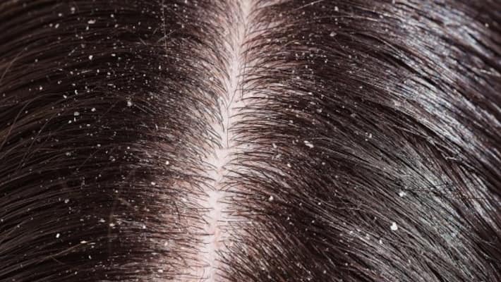 do you feel very shame about dandruff do you feel very shame about dandruff