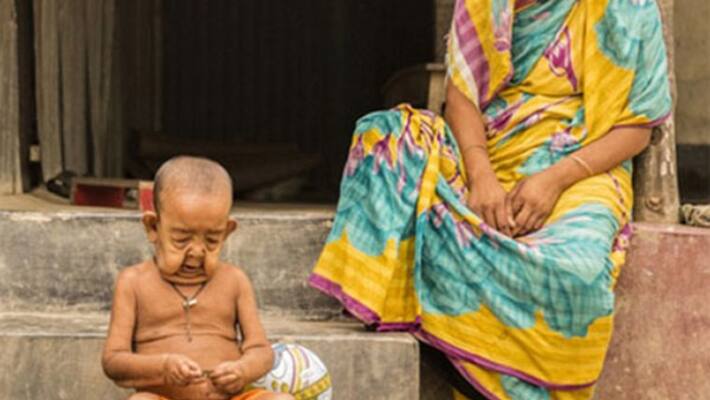 4-year-old kid with rare medical condition looks like an old man 4-year-old kid with rare medical condition looks like an old man