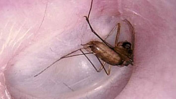 Do you know Salt solution to take the insect into the ears ... Do you know Salt solution to take the insect into the ears ...
